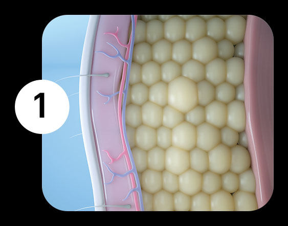 Stubborn fat - CoolSculpting
