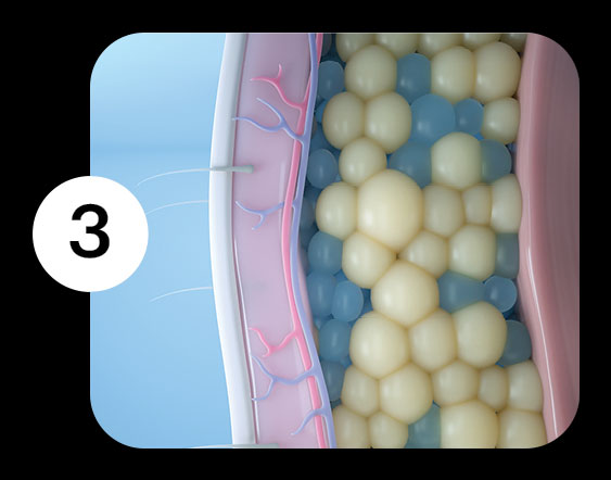 Fat cells eliminated - CoolSculpting