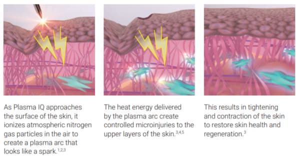 Plasma IQ - How it works?