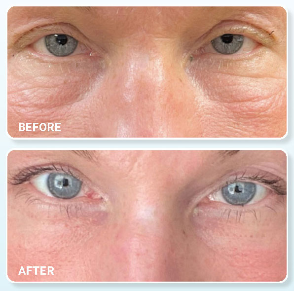 Plasma IQ - Before & After