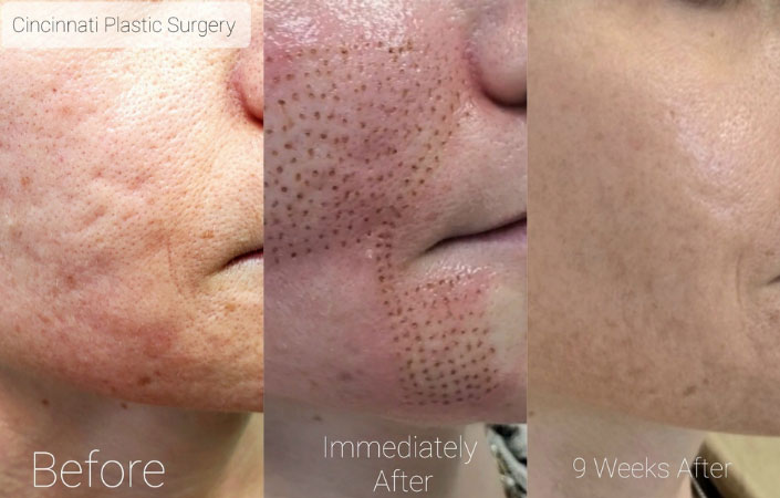 Plasma IQ - Before & After