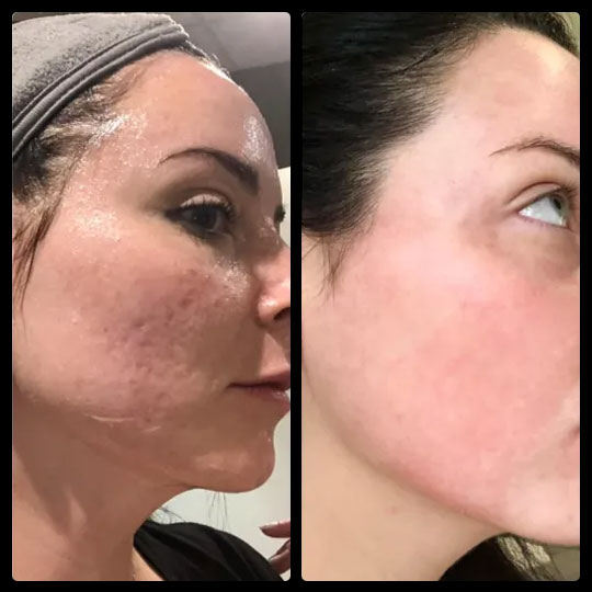 Before & After | IPL Laser Treatment