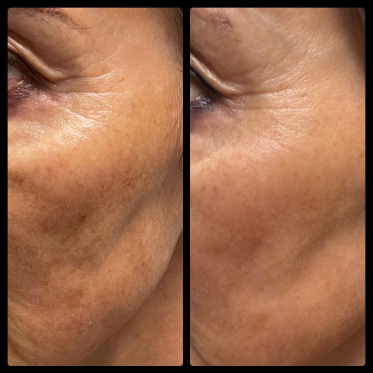 Before & After | IPL Laser Treatment