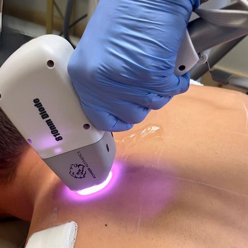 Laser Hair Removal
